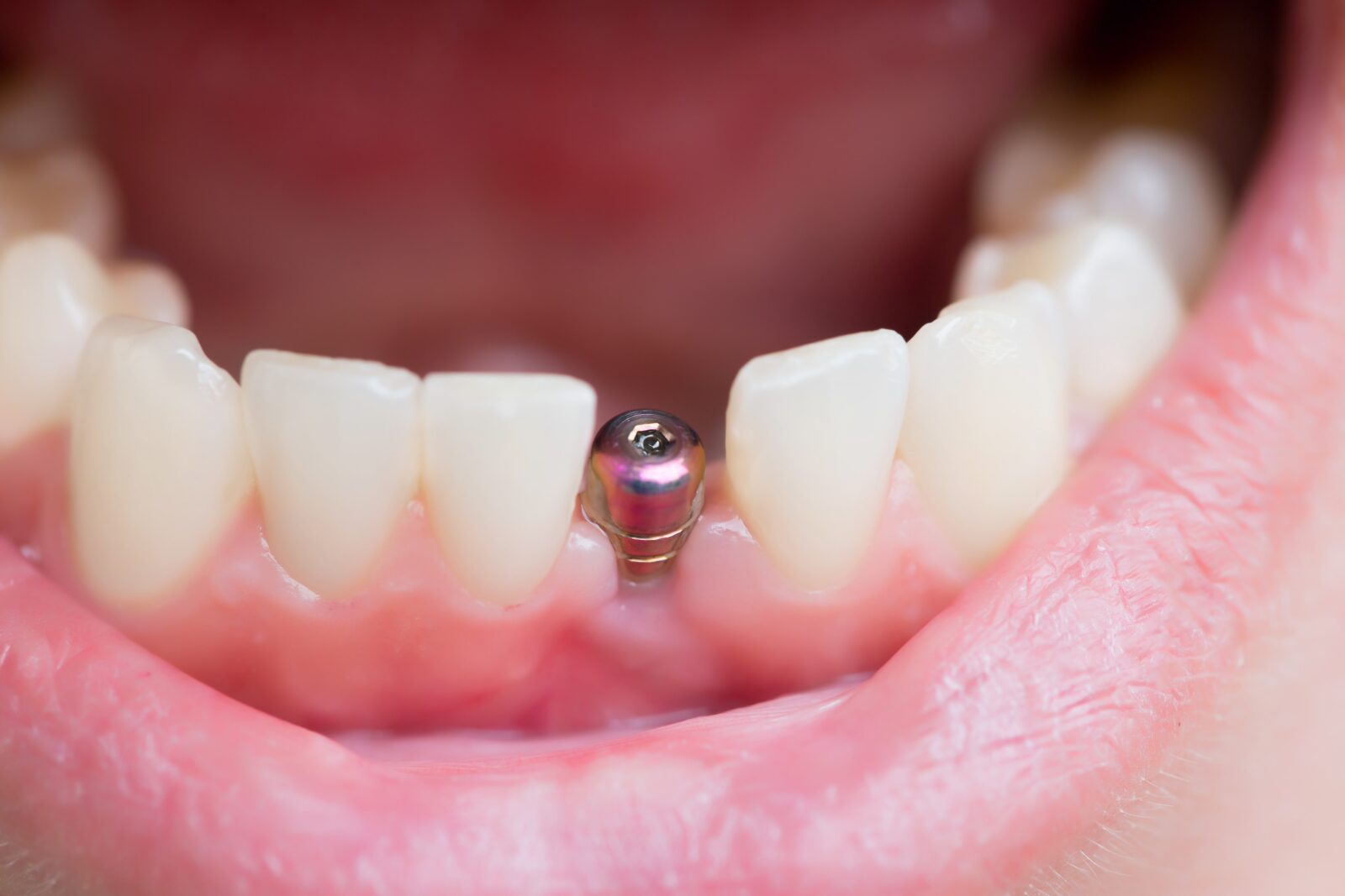 person smiling with a dental implant post sticking out of their gums