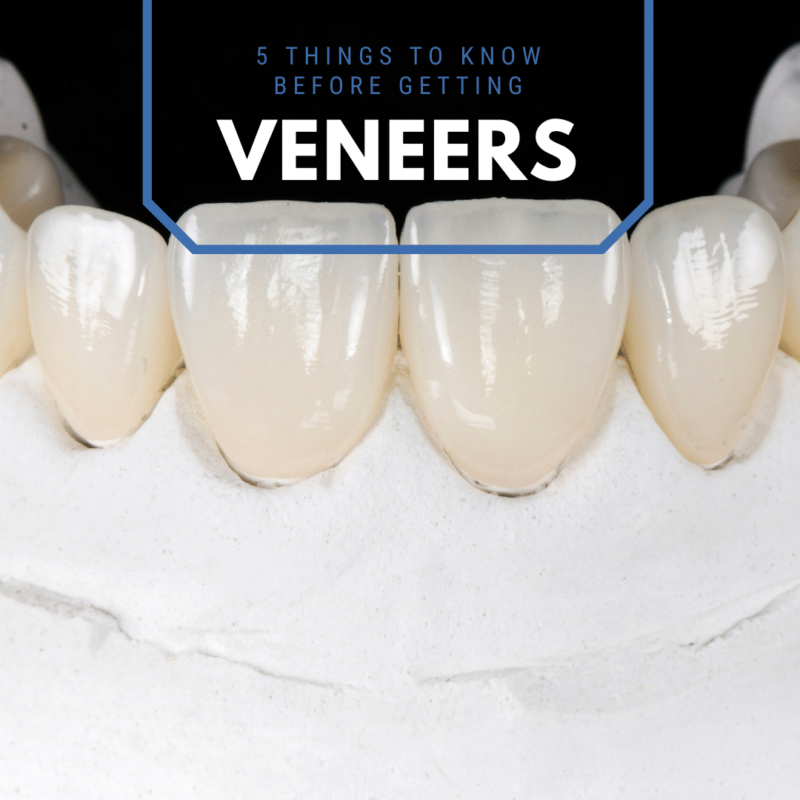 5 Things to Know Before Getting veneers