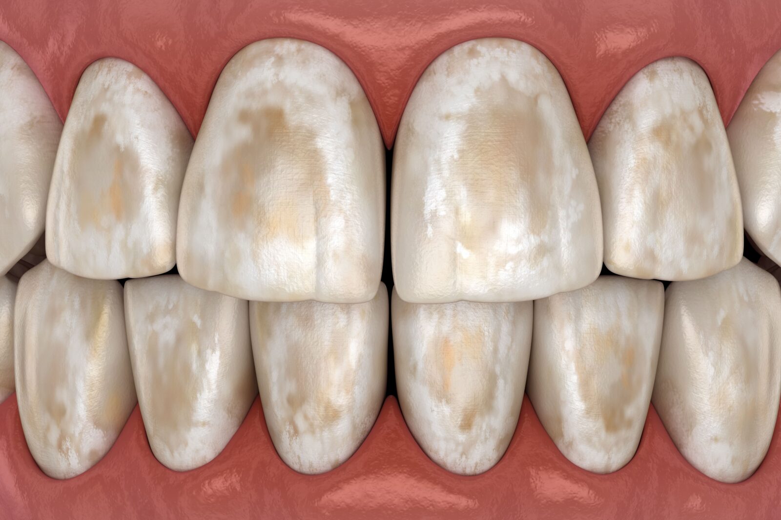 worn down tooth enamel