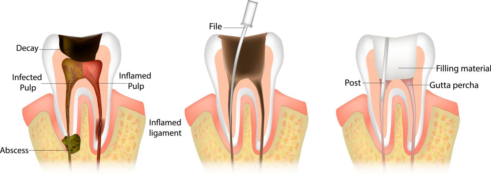 three steps of a root canal procedure