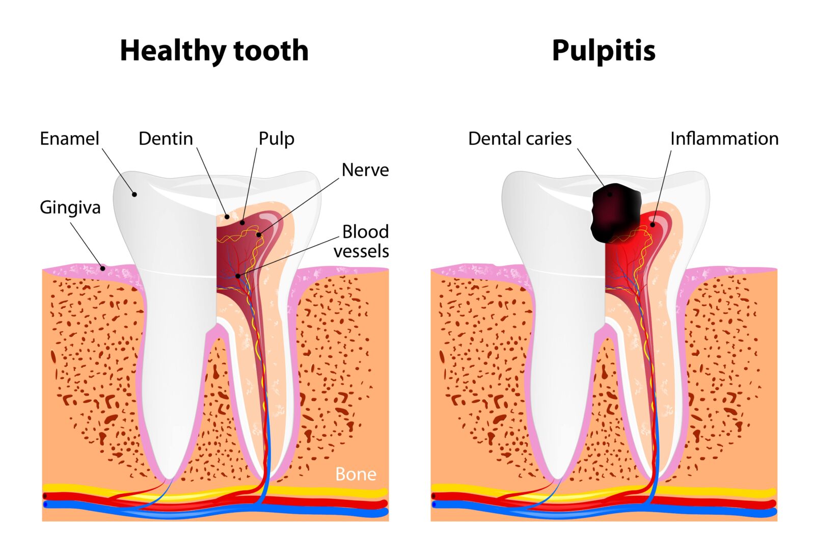 healthy tooth vs. pulpitis