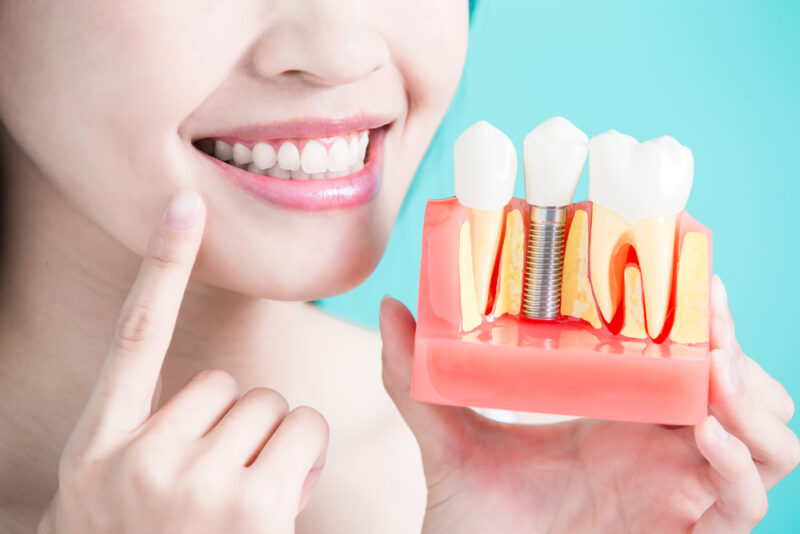 12 Dental Implant Facts