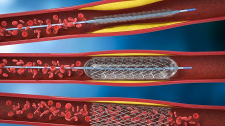 Angioplasty-And-Stenting