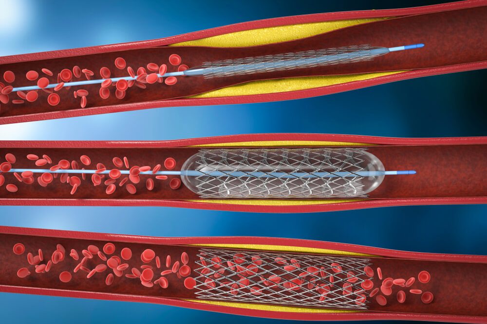 Angioplasty-And-Stenting