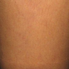 After Spider Vein Sclerotherapy