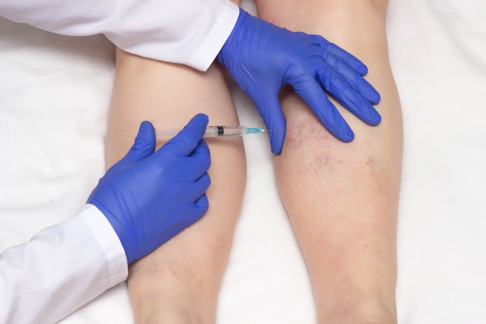 sclerotherapy Treatment For Varicose Veins