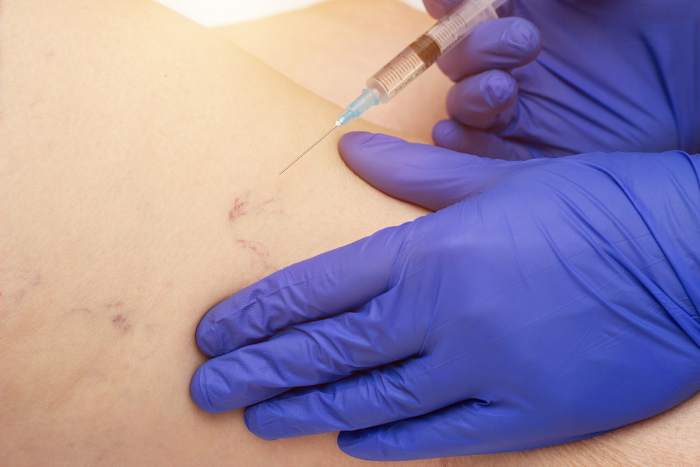 The,Doctor,Makes,An,Injection,Of,Sclerotherapy,In,Varicose,Veins,