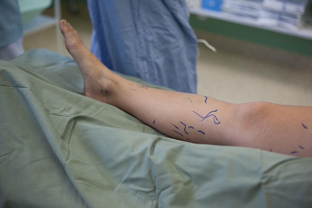 Operation,Of,Varicose,Veins,In,Operating,Room