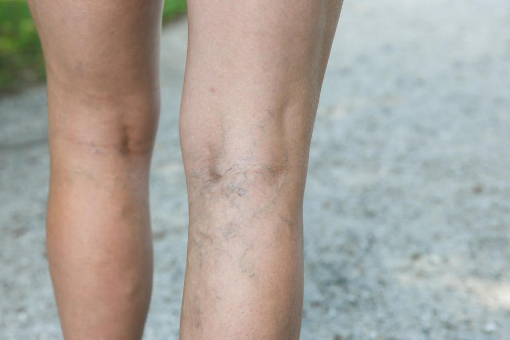 patient with visible leg veins