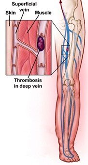 Varicose Vein Treatment Necessary for Deep Vein Thrombosis
