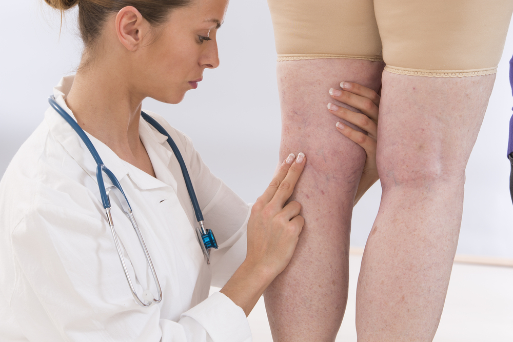 Doctor,Showing,Varicose,Veins,From,An,Elderly,Woman
