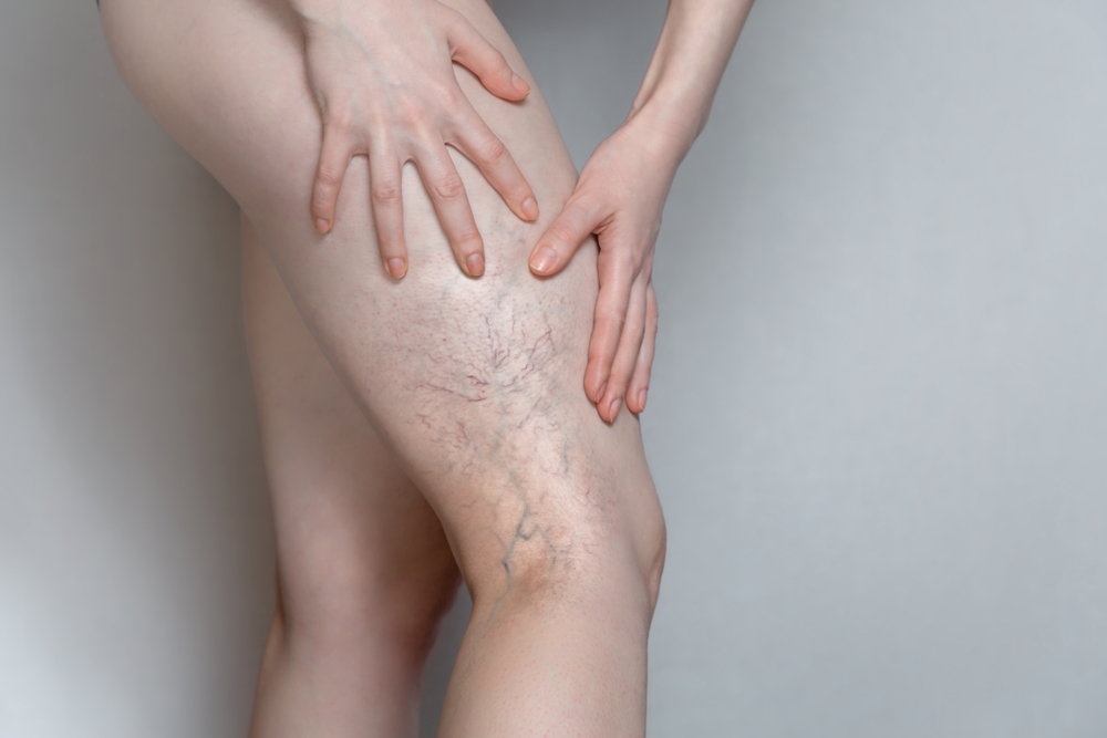 Woman,Shows,Leg,With,Varicose,Veins.,The,Concept,Of,Human