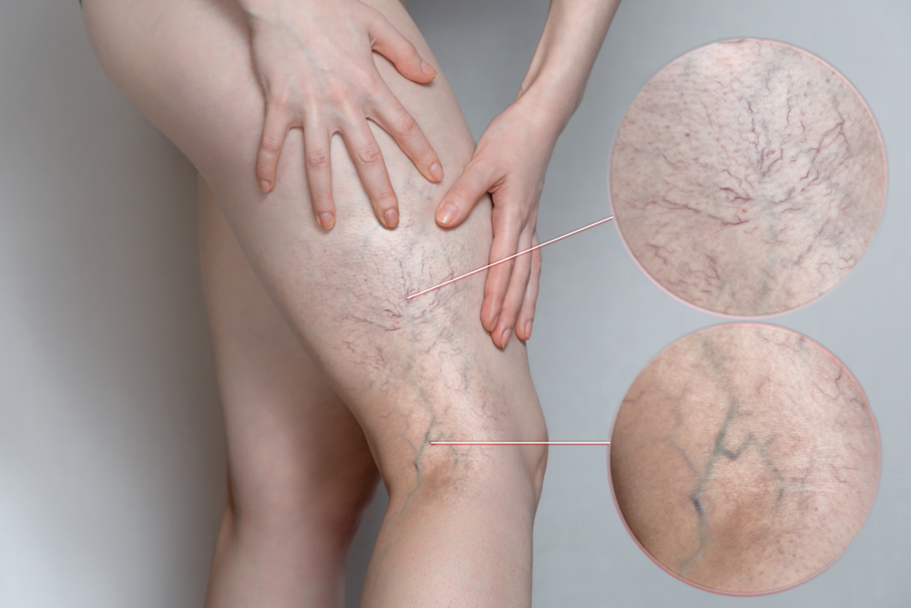Woman,Shows,Leg,With,Varicose,Veins.,Magnifying,The,Image.,The