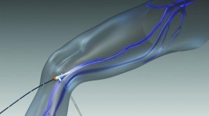 ClosureFast Procedure for Varicose Veins of Legs