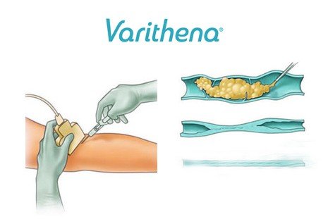 Varithena Endovovenous Chemical Ablation with Foam Injection Veins