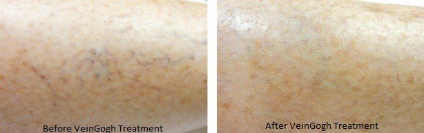 image of facial skin following VeinGogh vein treatment for face vein removal
