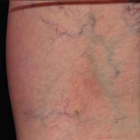 reticular veins