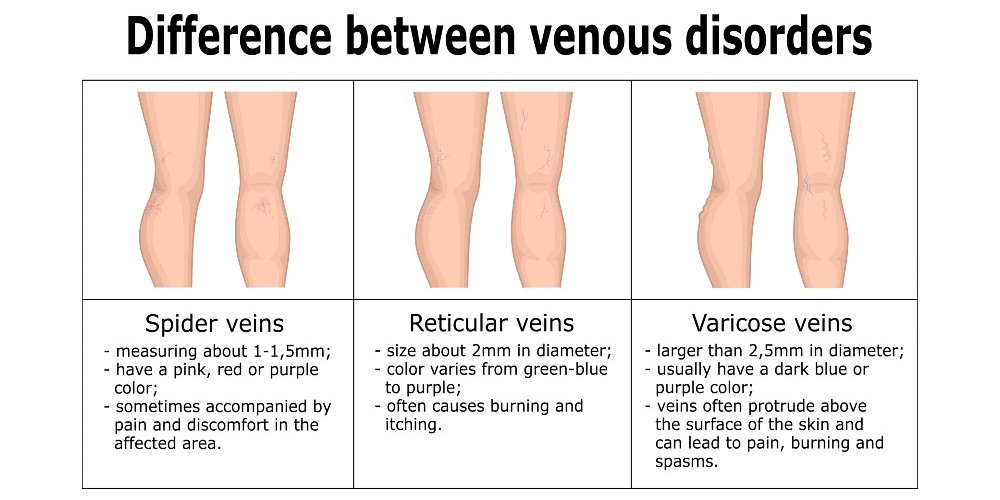 spider veins and varicose veins removal austin texas