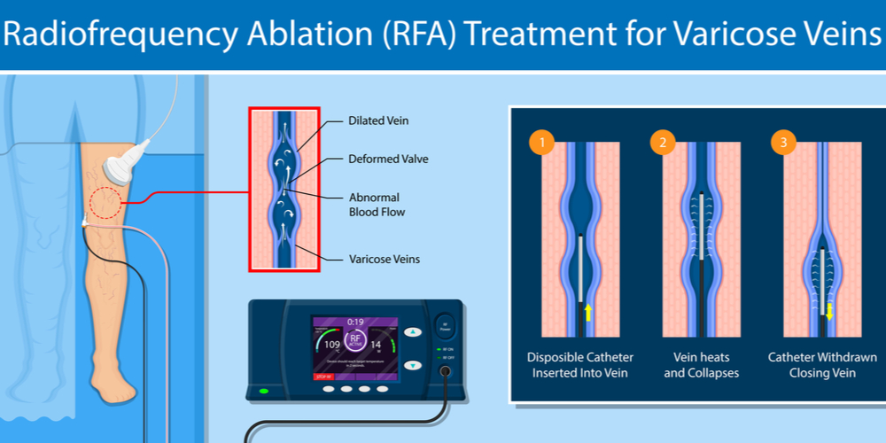 Saphenous Vein Ablation