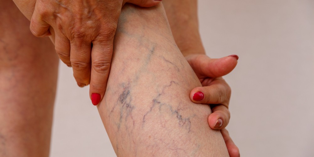 Elderly woman in white panties shows cellulite and varicose veins on a light isolated background.