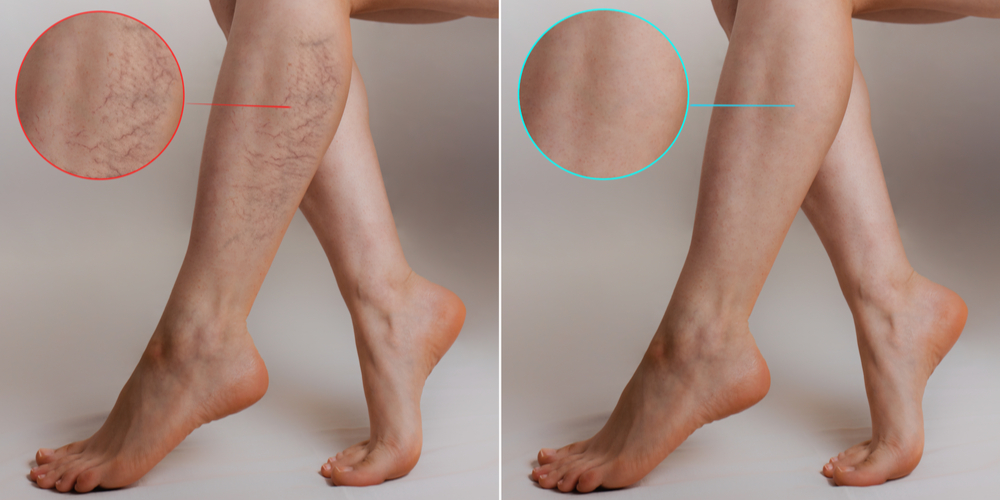 Medicine and health. The concept of female varicose veins. Female legs with vascular stars on the legs,