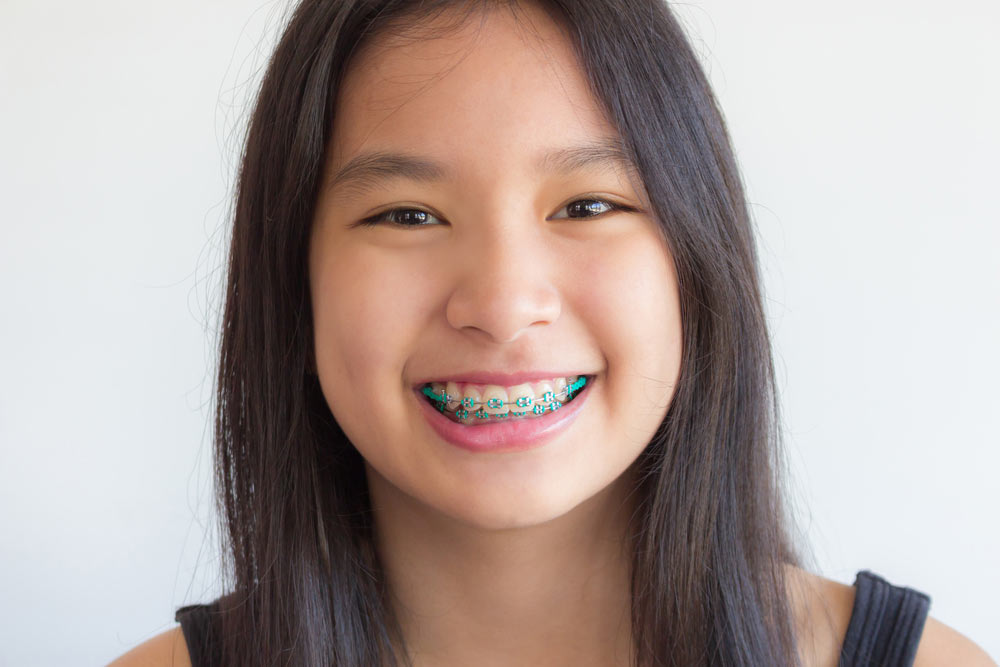 child having metal braces