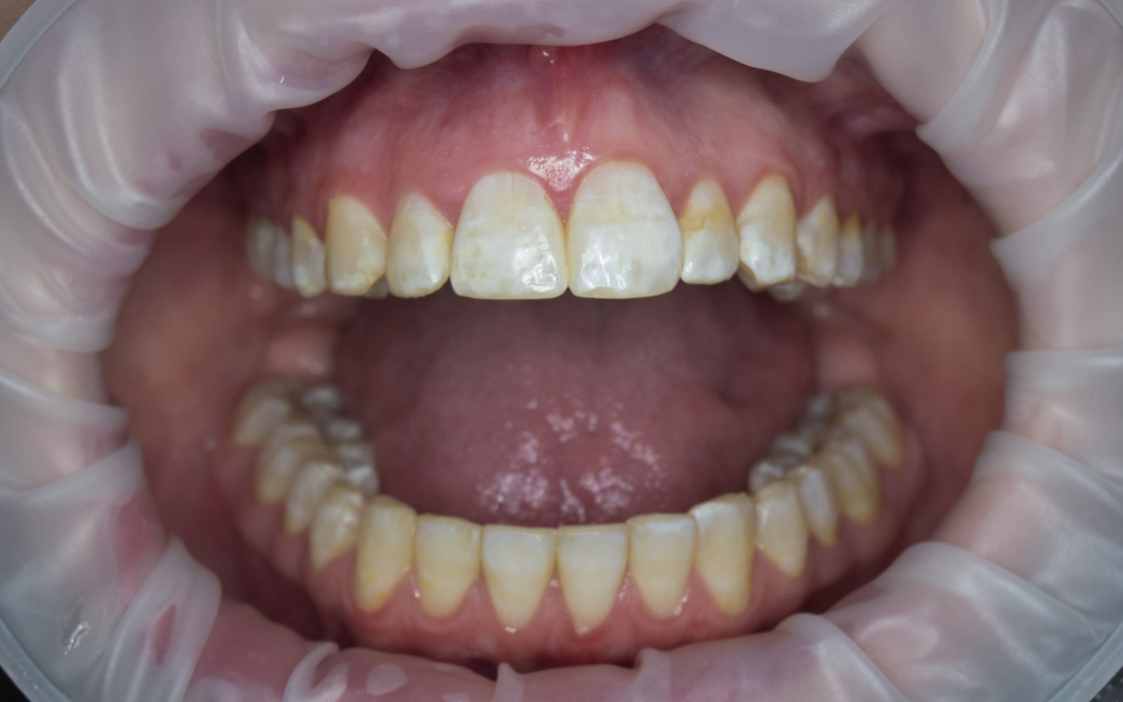 Teeth affected by fluorosis