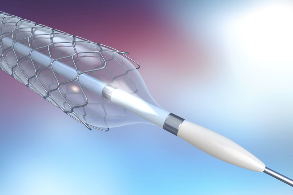 catheter for stent implantation for supporting blood circulation