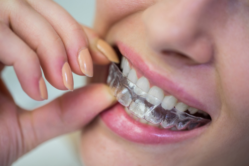 porcelain veneers, Invisalign