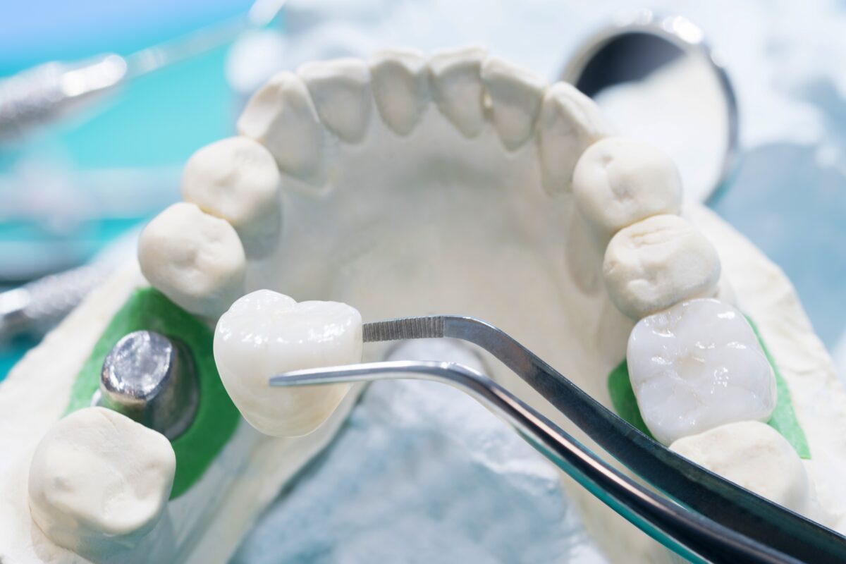 Dental crowns and dental bridges