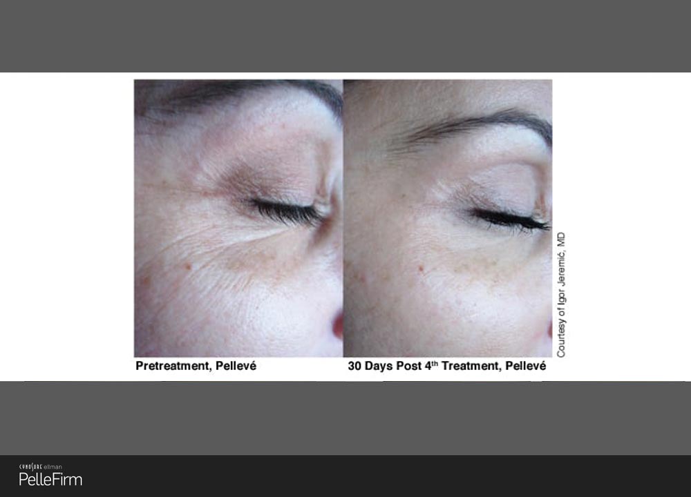 2-Pelleve-Before-After-Treatment
