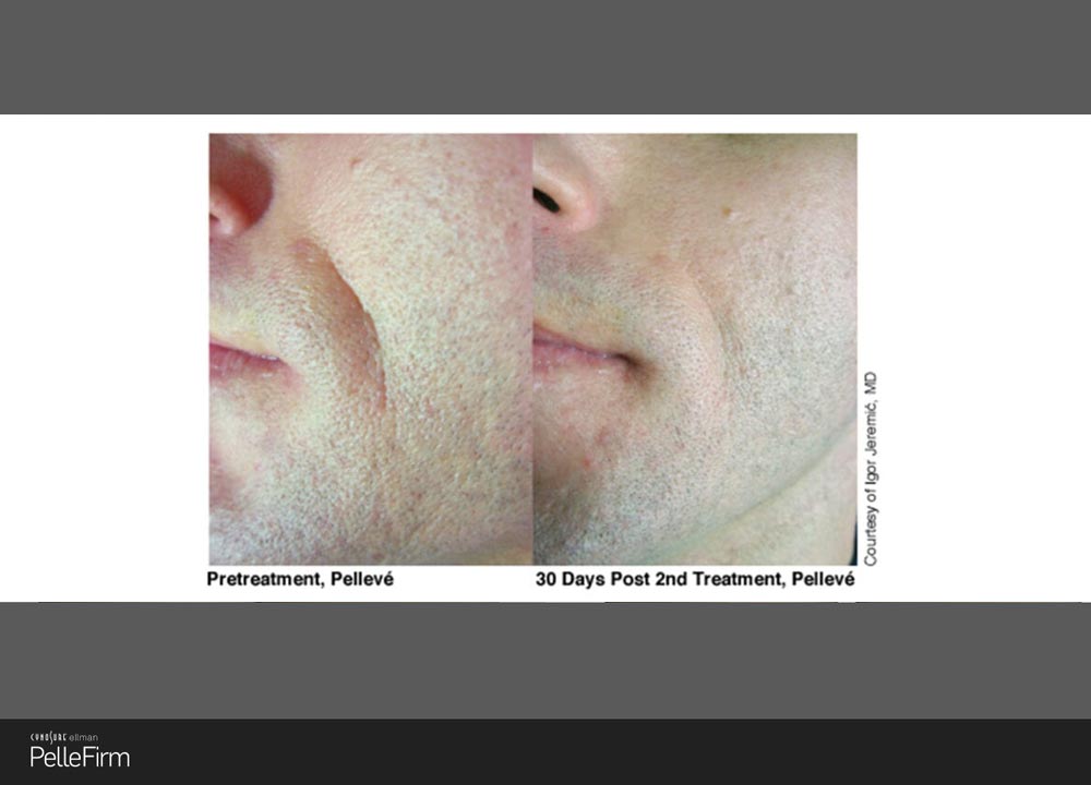 4-Pelleve-Before-After-Treatment