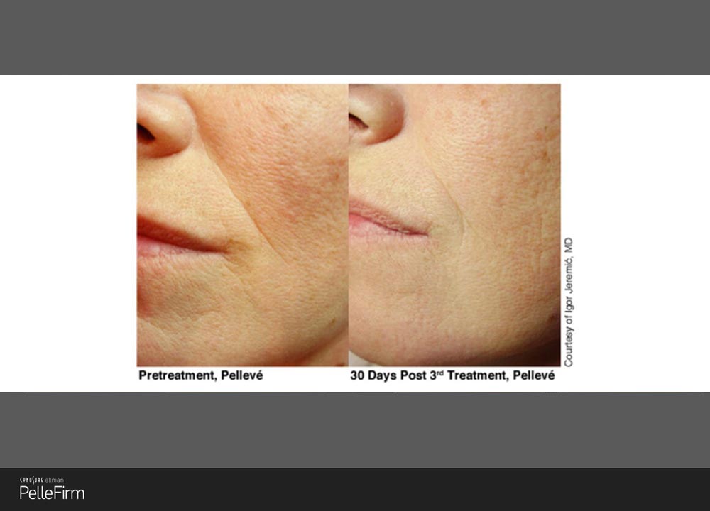 7-Pelleve-Before-After-Treatment-