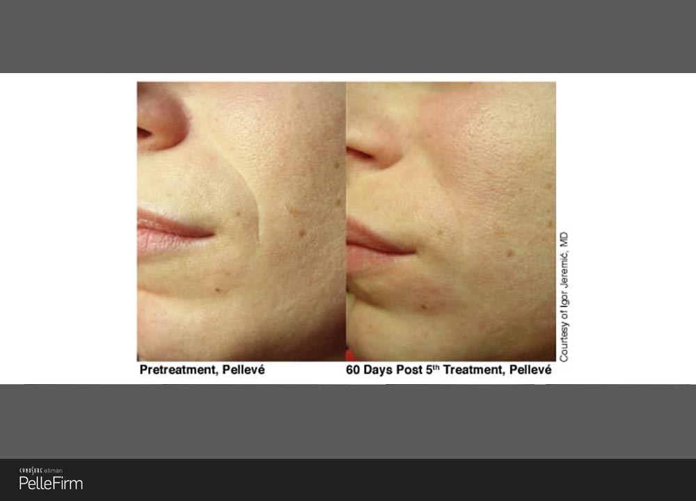 9-Pelleve-Before-After-Treatment