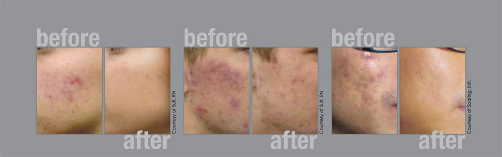 Acne and acne scars treatment 2 showing the concept of Fotona TwinLight™ Laser Acne & Acne Scars Treatment