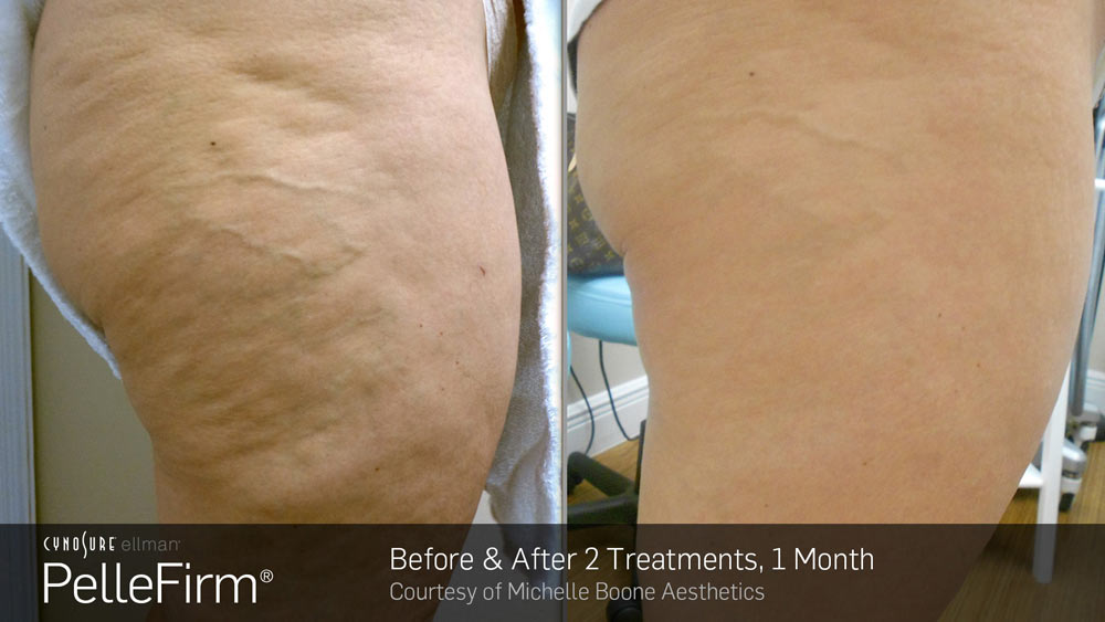 Skin Tightening and Anti-Cellulite Treatment Montreal