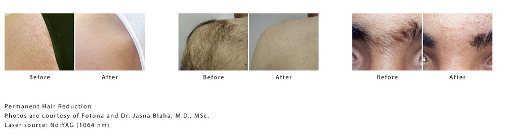 Fotona-Hair-Removal-Before-and-After