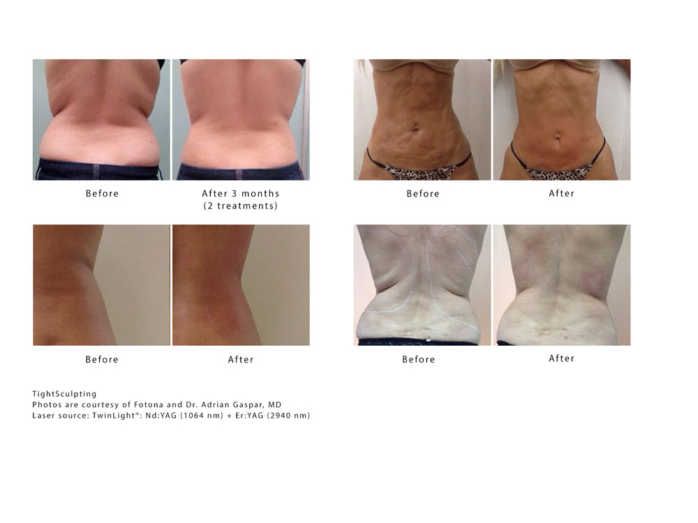 Reshape your Body with Fotona TightSculpting Laser Treatment
