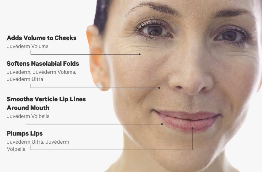 JUVEDERM Treatment Area Infographic png 876x576 1 showing the concept of Dermal Fillers | Toronto