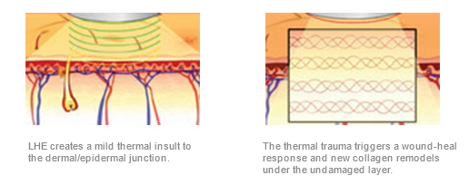 Examining Light Heat Energy (LHE) Skin Rejuvenation