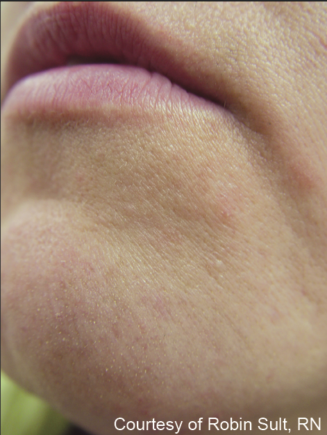Women's thin lips wrinkles