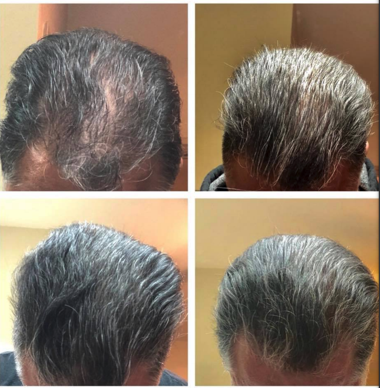 Men'shair after using cosmetic powder for hair thickening. Before and after