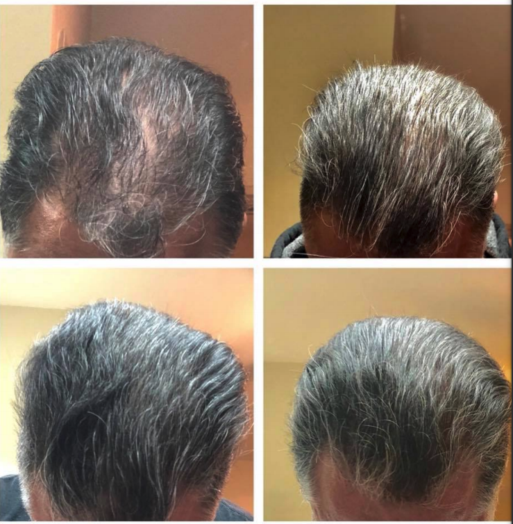 hair loss treatment