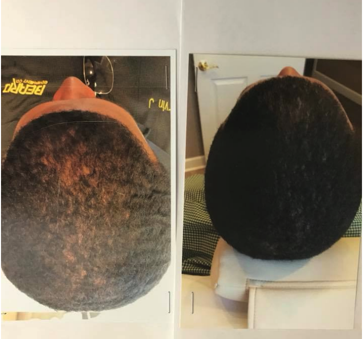 Men'shair after using cosmetic powder for hair thickening. Before and after