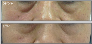 Senior man before and after biorevitalization procedure, closeup
