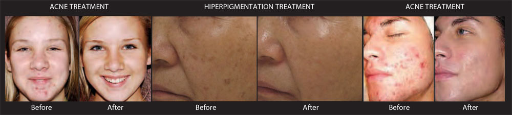 SilkPeel-before-and-after