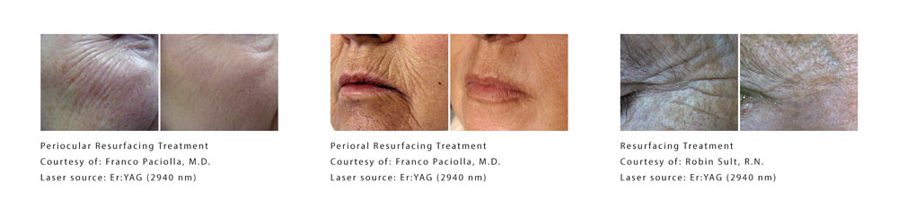 TwinLight-Fractional-Rejuvenation-before-and-after