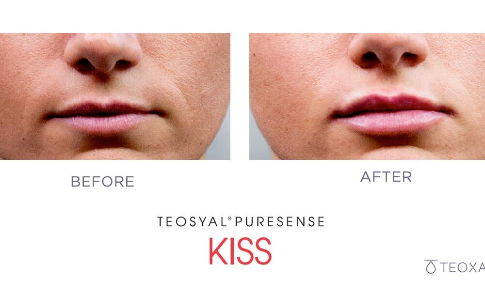 Teosyal Kiss before and after; lip enhancement and symmetry