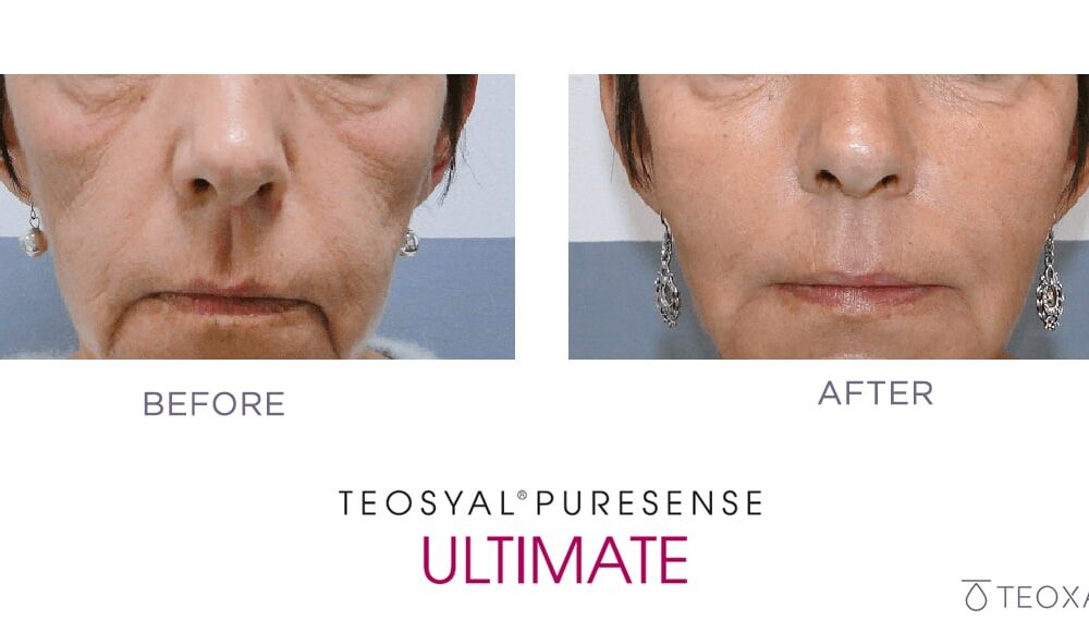 Teosyal dermal filler before and after - cheek contouring nasolibial fold, smoker's line, marionette line correction, eye bag reduction, tear trough filler