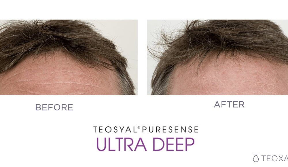 Teosyal before and after - dermal filler injection for temple volume enhancement